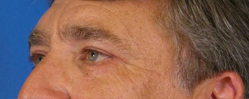 Eyelid Lift Before & After Gallery - Patient 391533 - Image 4