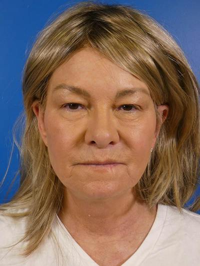 Eyelid Lift Before & After Gallery - Patient 513594 - Image 1