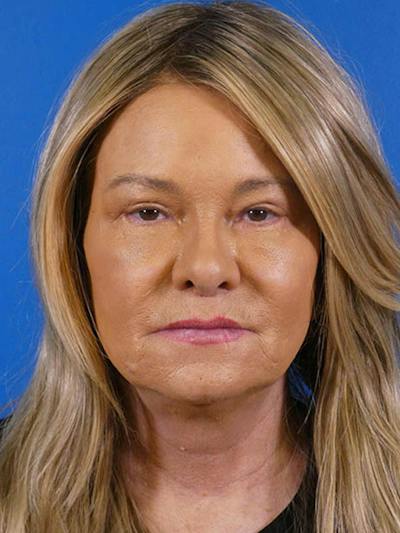 Eyelid Lift Before & After Gallery - Patient 513594 - Image 2