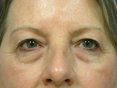 Eyelid Lift Before & After Gallery - Patient 195292 - Image 1