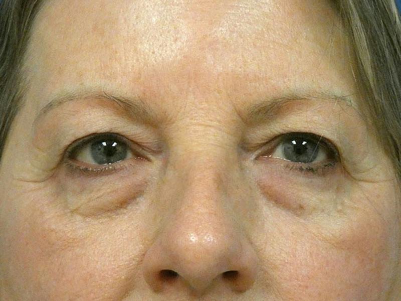 Eyelid Lift Before & After Gallery - Patient 195292 - Image 1