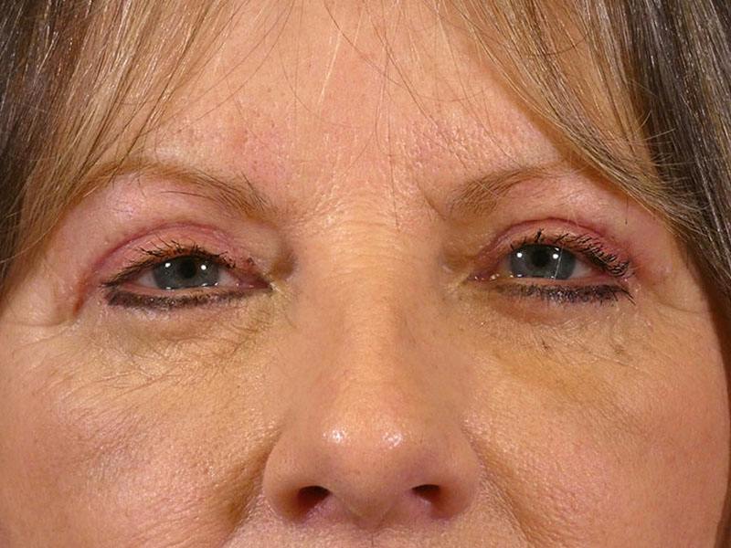 Eyelid Lift Before & After Gallery - Patient 195292 - Image 2