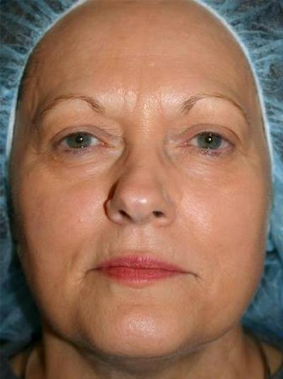 Eyelid Lift Before & After Gallery - Patient 589410 - Image 1