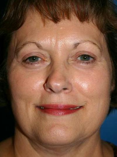 Eyelid Lift Before & After Gallery - Patient 589410 - Image 2