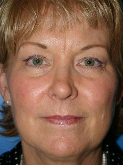 Eyelid Lift Before & After Gallery - Patient 265756 - Image 1
