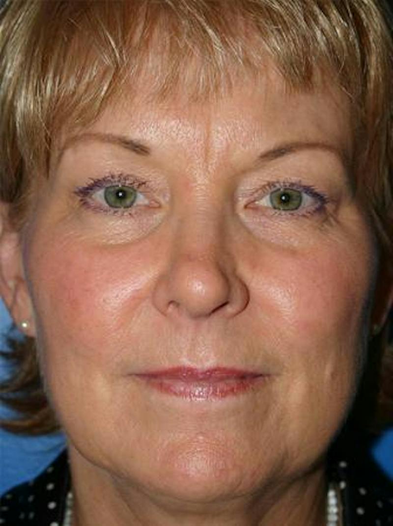 Eyelid Lift Before & After Gallery - Patient 265756 - Image 1