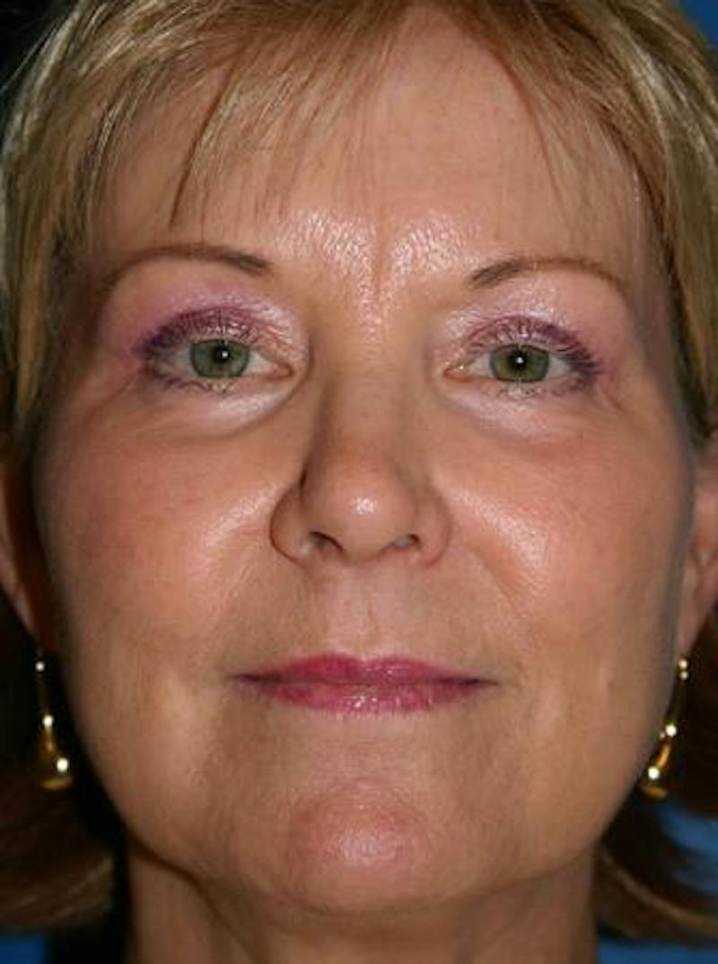 Eyelid Lift Before & After Gallery - Patient 265756 - Image 2