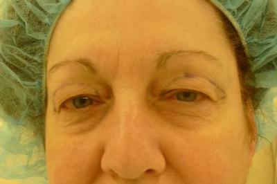 Eyelid Lift Before & After Gallery - Patient 409236 - Image 1
