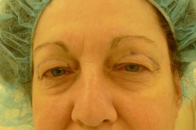 Eyelid Lift Before & After Gallery - Patient 409236 - Image 1