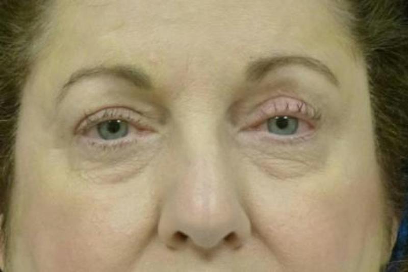 Eyelid Lift Before & After Gallery - Patient 409236 - Image 2