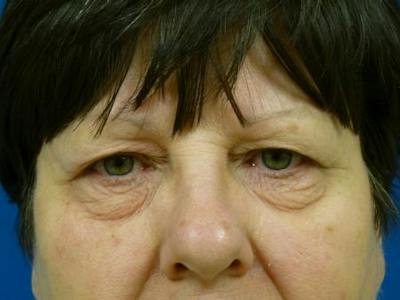 Eyelid Lift Before & After Gallery - Patient 137588 - Image 1