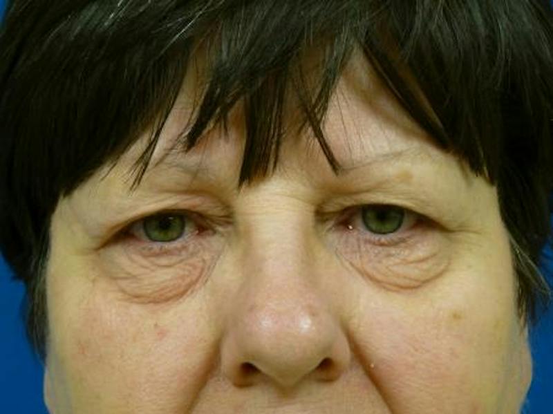 Eyelid Lift Before & After Gallery - Patient 137588 - Image 1