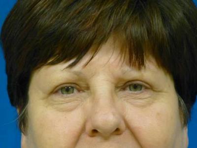 Eyelid Lift Before & After Gallery - Patient 137588 - Image 2
