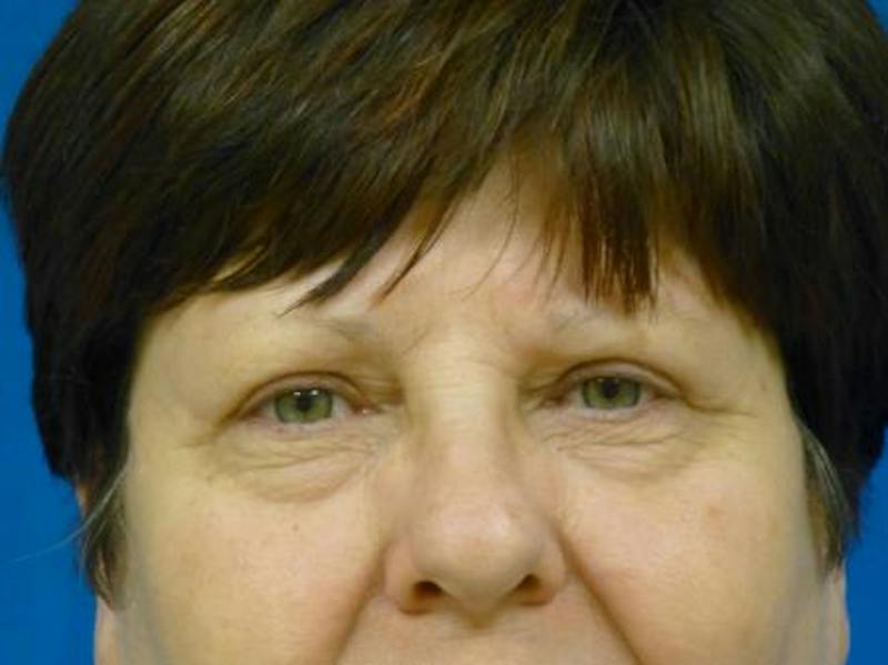 Eyelid Lift Before & After Gallery - Patient 137588 - Image 2