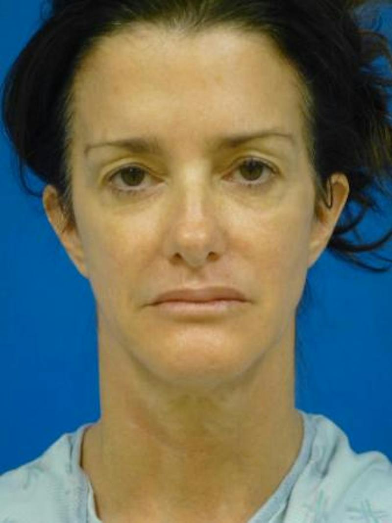 Eyelid Lift Before & After Gallery - Patient 240516 - Image 1