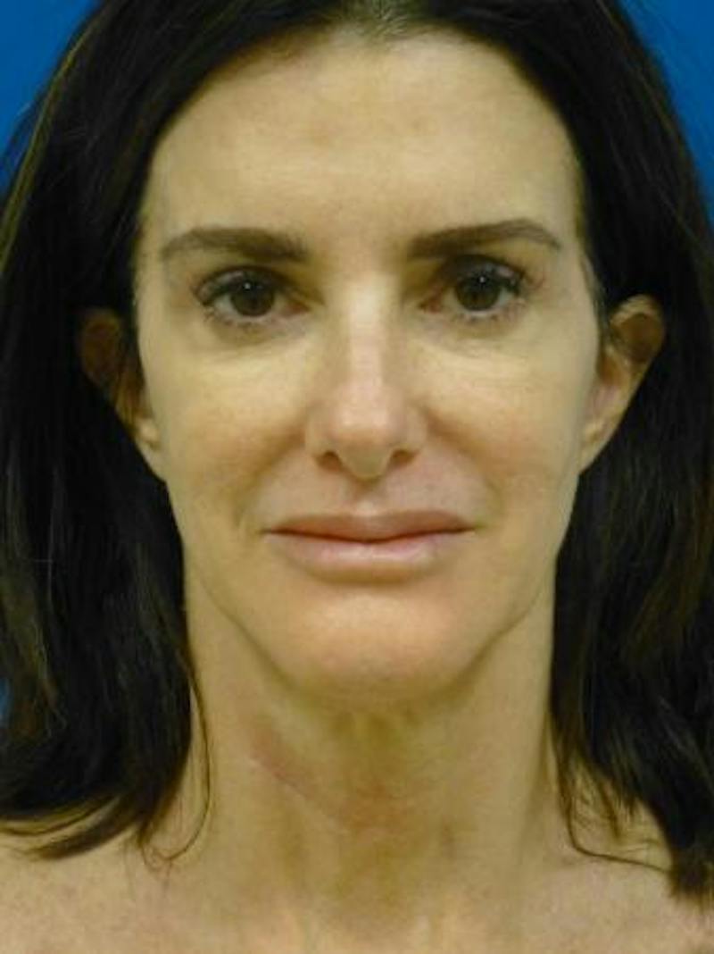 Eyelid Lift Before & After Gallery - Patient 240516 - Image 2