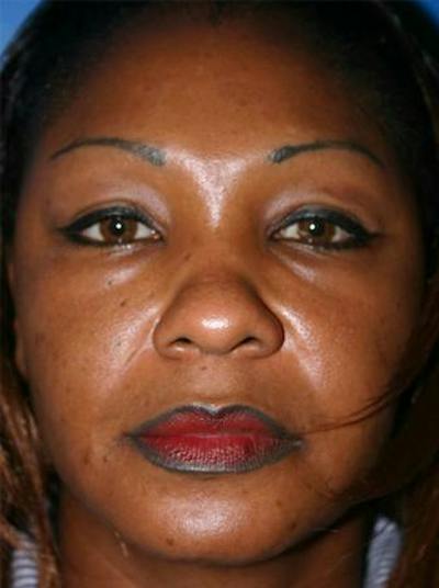 Eyelid Lift Before & After Gallery - Patient 170535 - Image 1