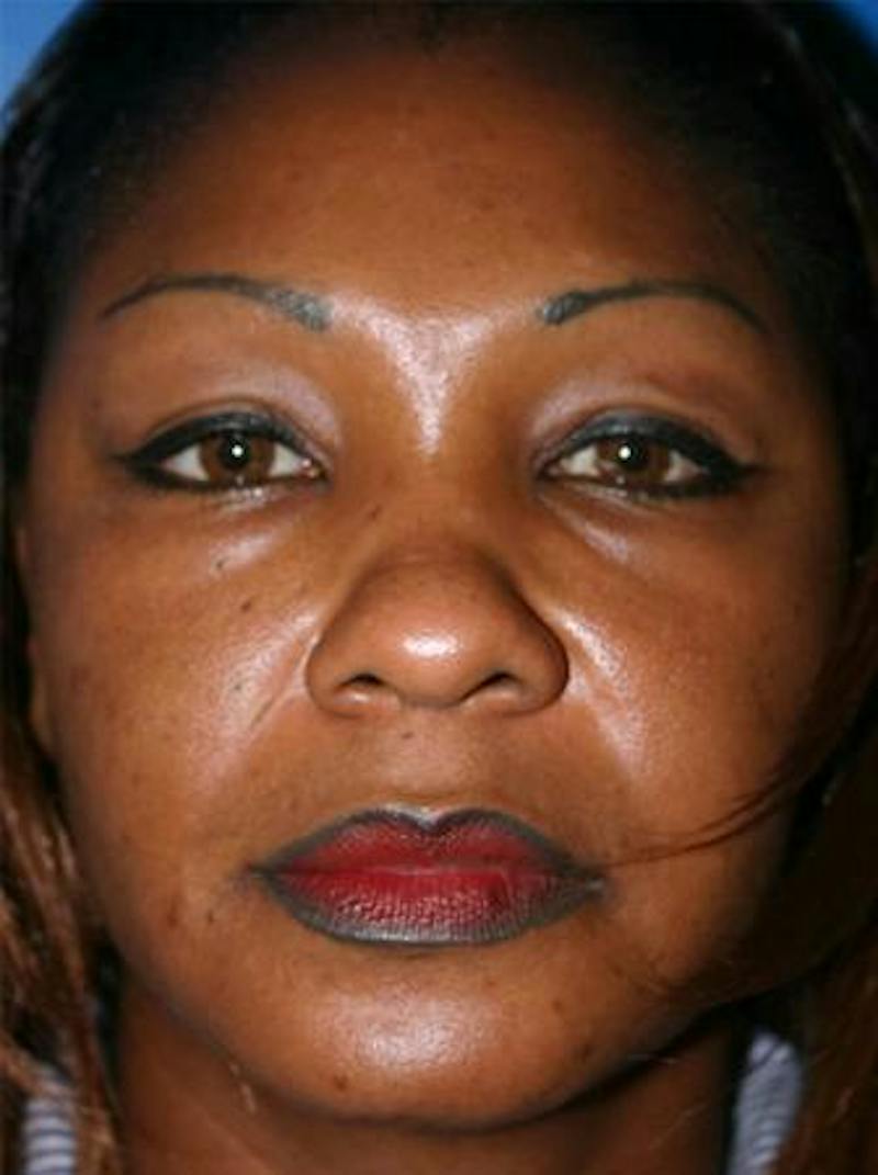 Eyelid Lift Before & After Gallery - Patient 170535 - Image 1