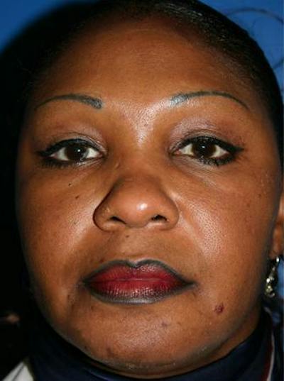 Eyelid Lift Before & After Gallery - Patient 170535 - Image 2