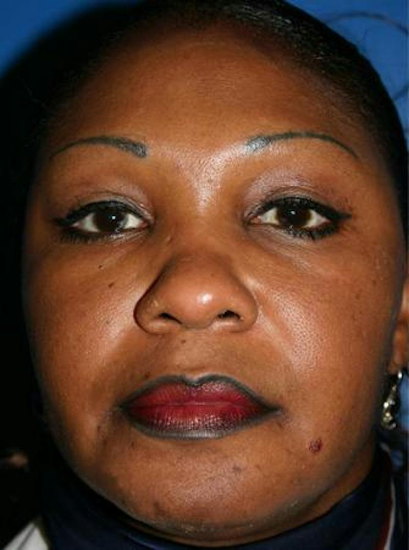 Eyelid Lift Before & After Gallery - Patient 170535 - Image 2