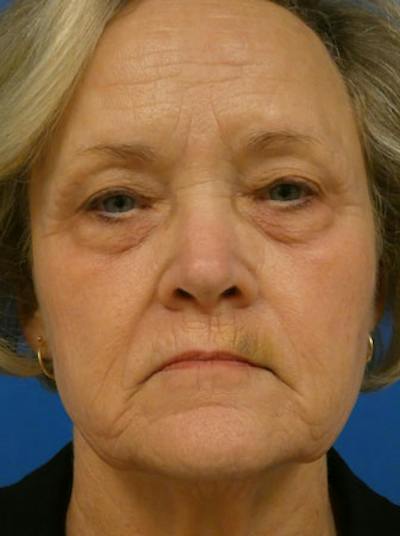 Eyelid Lift Before & After Gallery - Patient 845644 - Image 1