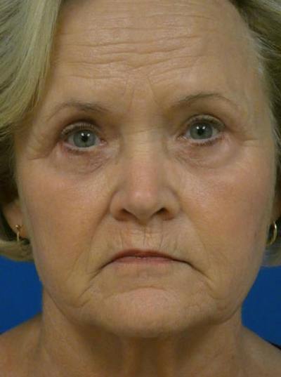 Eyelid Lift Before & After Gallery - Patient 845644 - Image 2