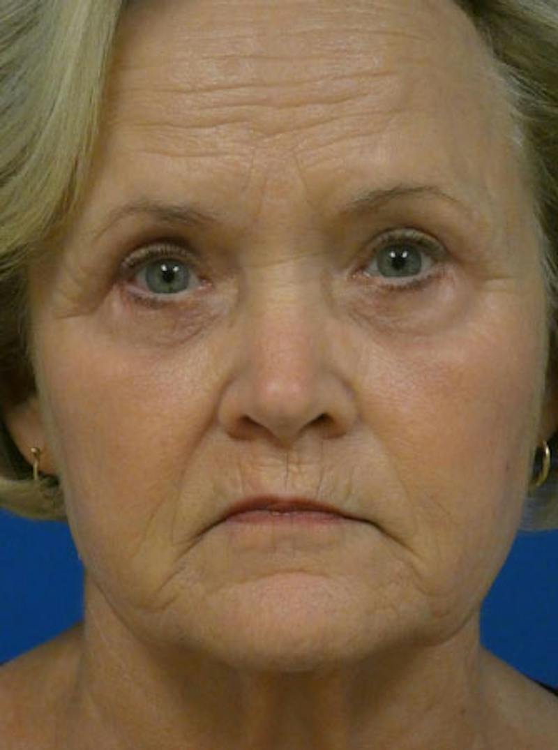 Eyelid Lift Before & After Gallery - Patient 845644 - Image 2
