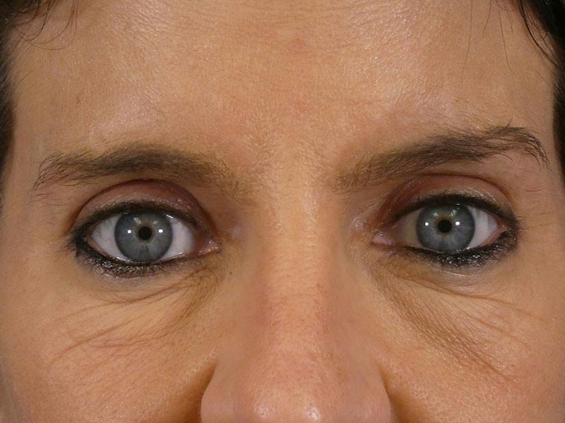 Eyelid Lift Before & After Gallery - Patient 344268 - Image 1