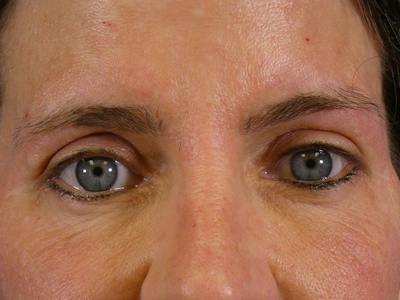 Eyelid Lift Before & After Gallery - Patient 344268 - Image 2