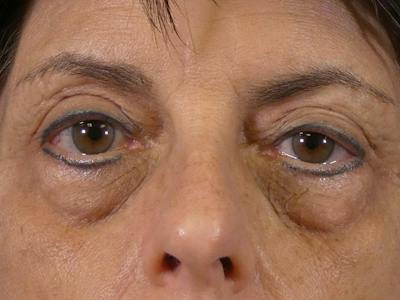 Eyelid Lift Before & After Gallery - Patient 264488 - Image 1