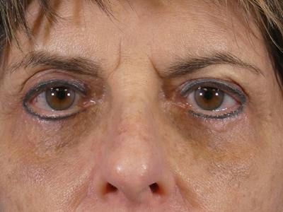 Eyelid Lift Before & After Gallery - Patient 264488 - Image 2