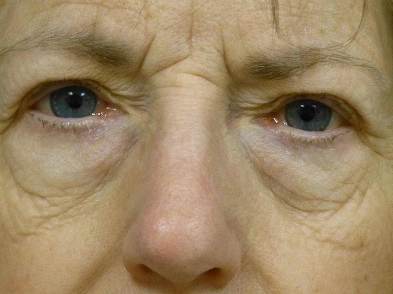 Eyelid Lift Before & After Gallery - Patient 281576 - Image 1