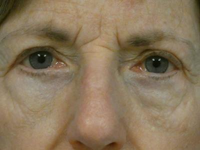 Eyelid Lift Before & After Gallery - Patient 281576 - Image 2