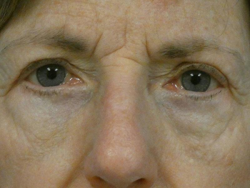 Eyelid Lift Before & After Gallery - Patient 281576 - Image 2