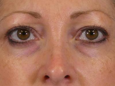 Eyelid Lift Before & After Gallery - Patient 238790 - Image 1