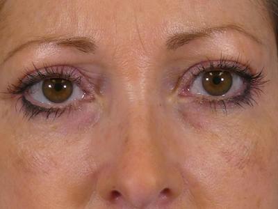 Eyelid Lift Before & After Gallery - Patient 238790 - Image 2
