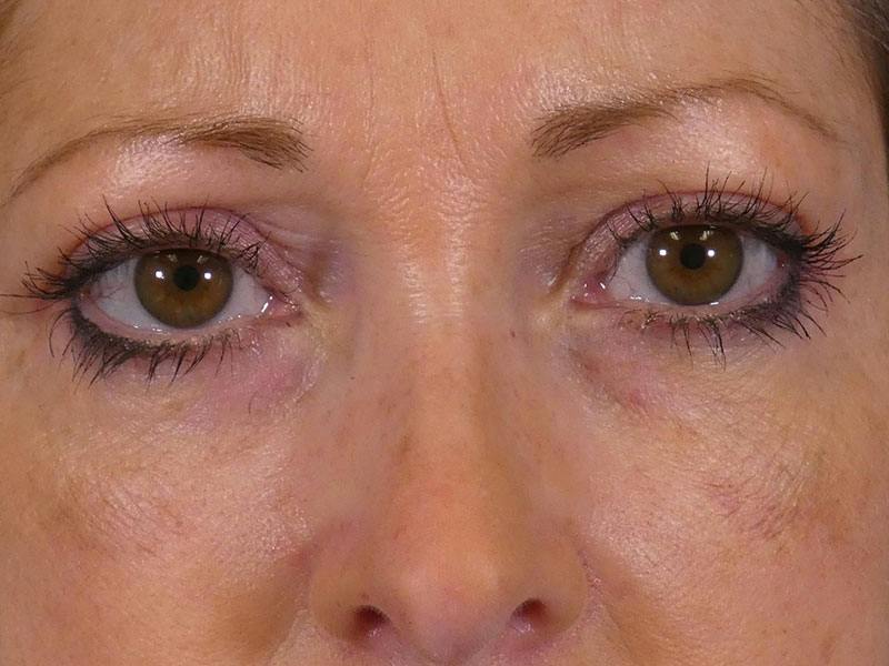 Eyelid Lift Before & After Gallery - Patient 238790 - Image 2
