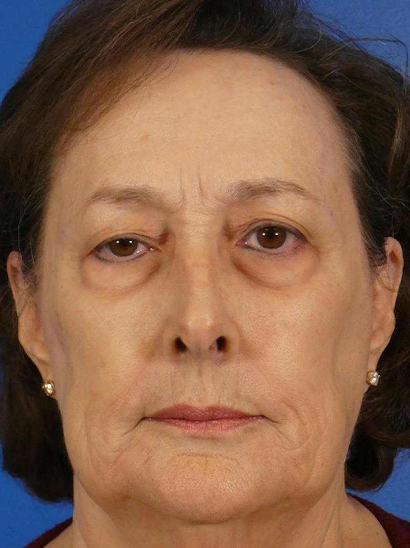 Eyelid Lift Before & After Gallery - Patient 129518 - Image 1