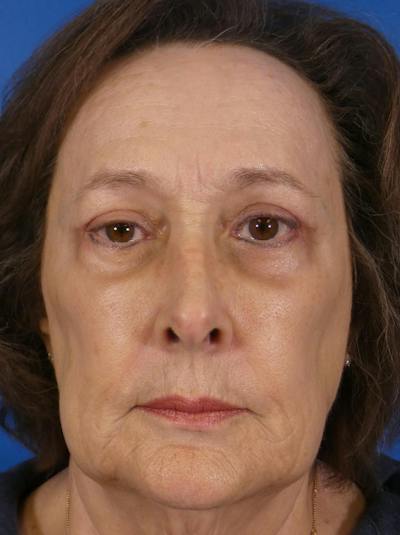 Eyelid Lift Before & After Gallery - Patient 129518 - Image 2