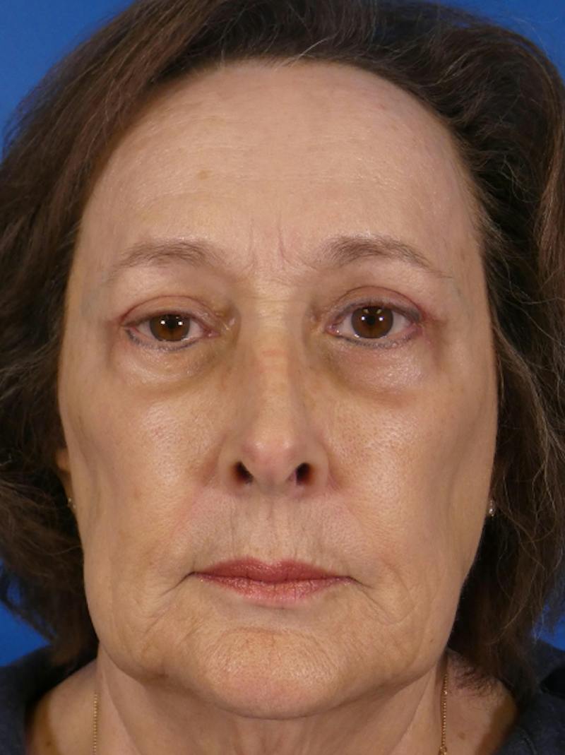 Eyelid Lift Before & After Gallery - Patient 129518 - Image 2