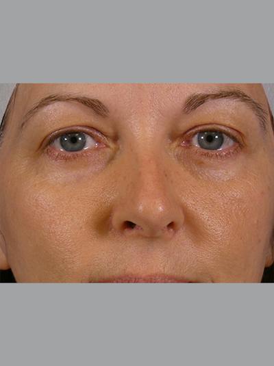 Eyelid Lift Before & After Gallery - Patient 275254 - Image 1