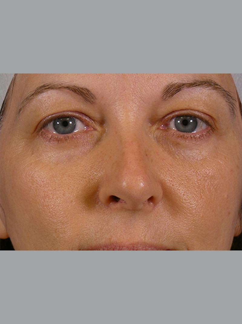 Eyelid Lift Before & After Gallery - Patient 275254 - Image 1