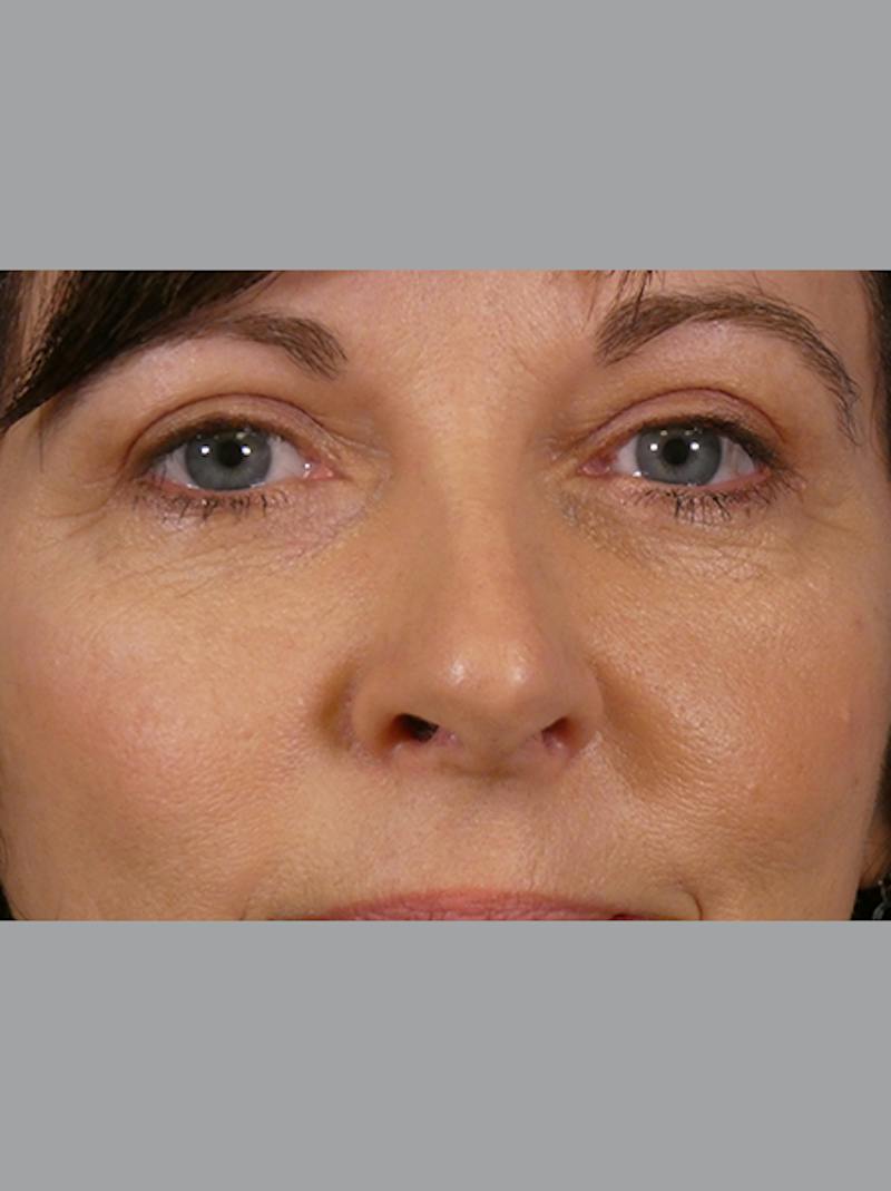 Eyelid Lift Before & After Gallery - Patient 275254 - Image 2