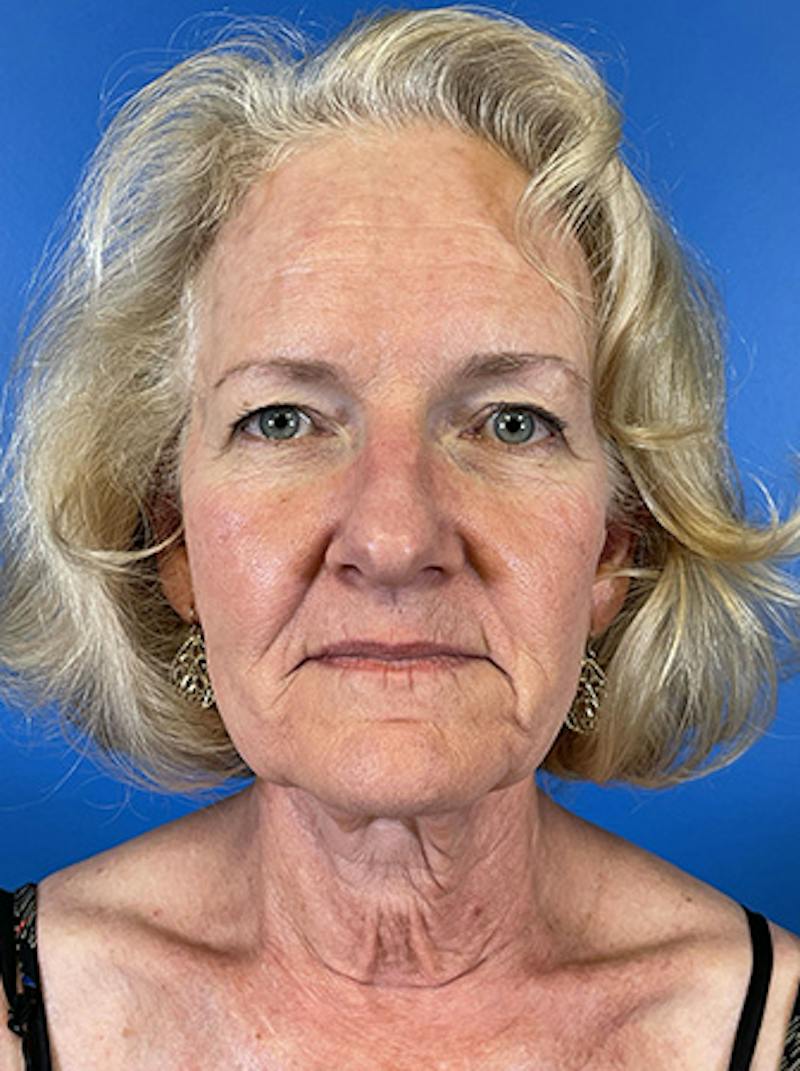 Facelift Before & After Gallery - Patient 313354 - Image 1