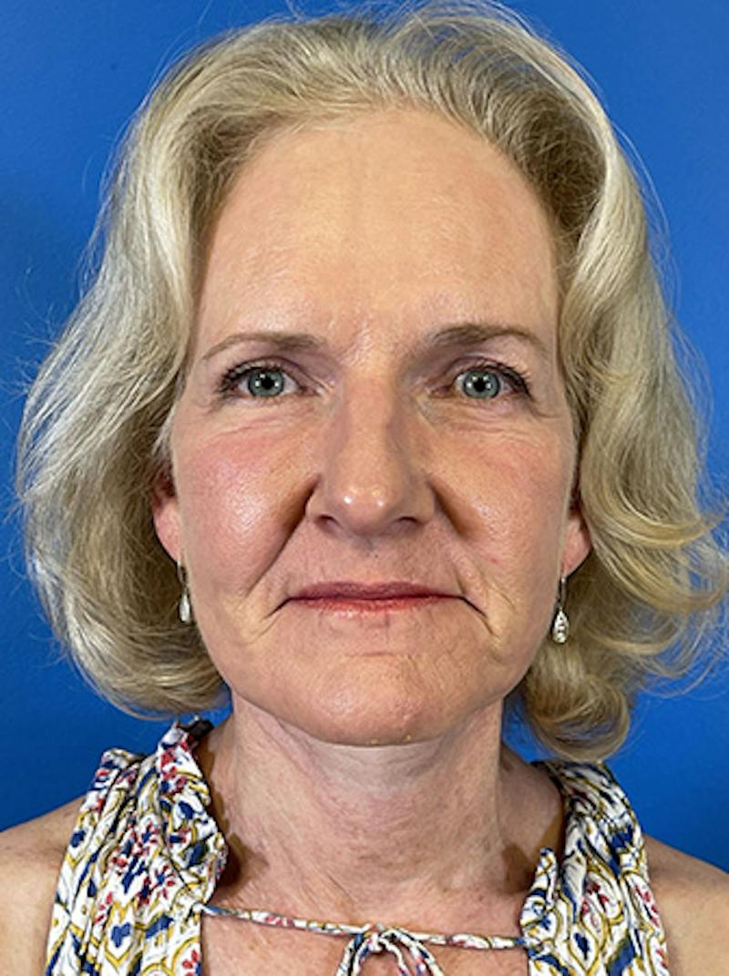 Facelift Before & After Gallery - Patient 313354 - Image 2