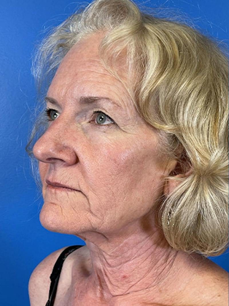 Facelift Before & After Gallery - Patient 313354 - Image 3