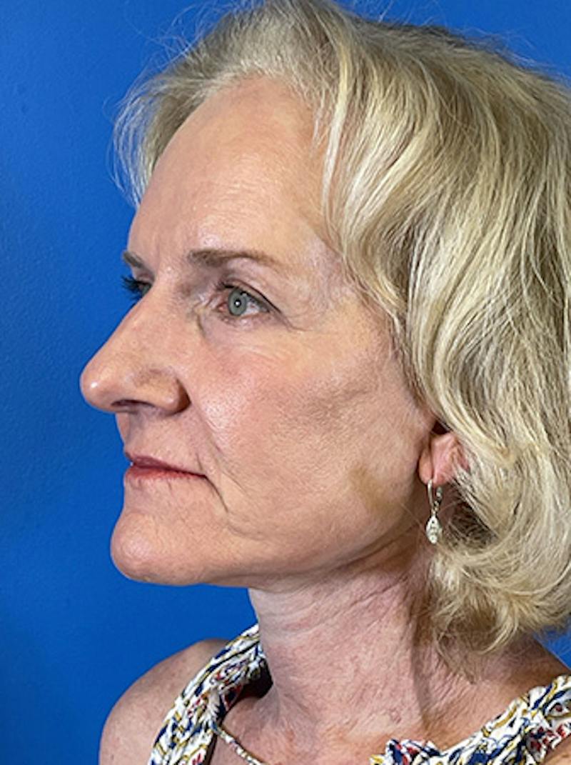 Facelift Before & After Gallery - Patient 313354 - Image 4