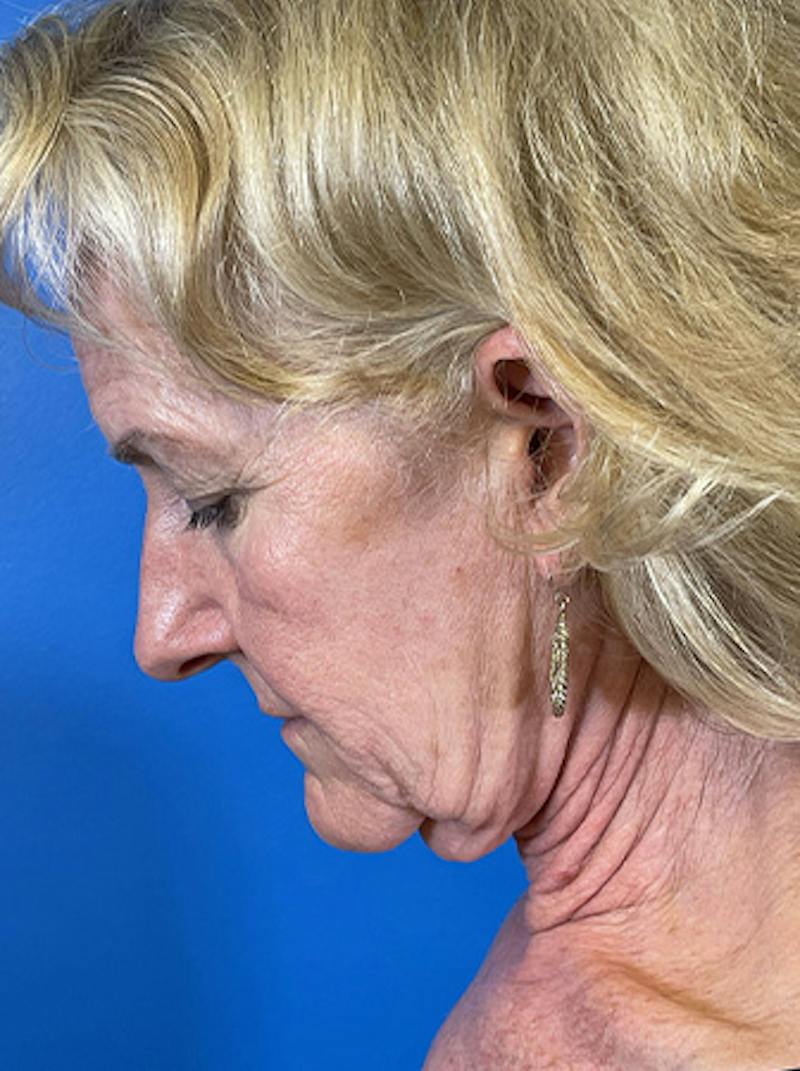 Facelift Before & After Gallery - Patient 313354 - Image 5