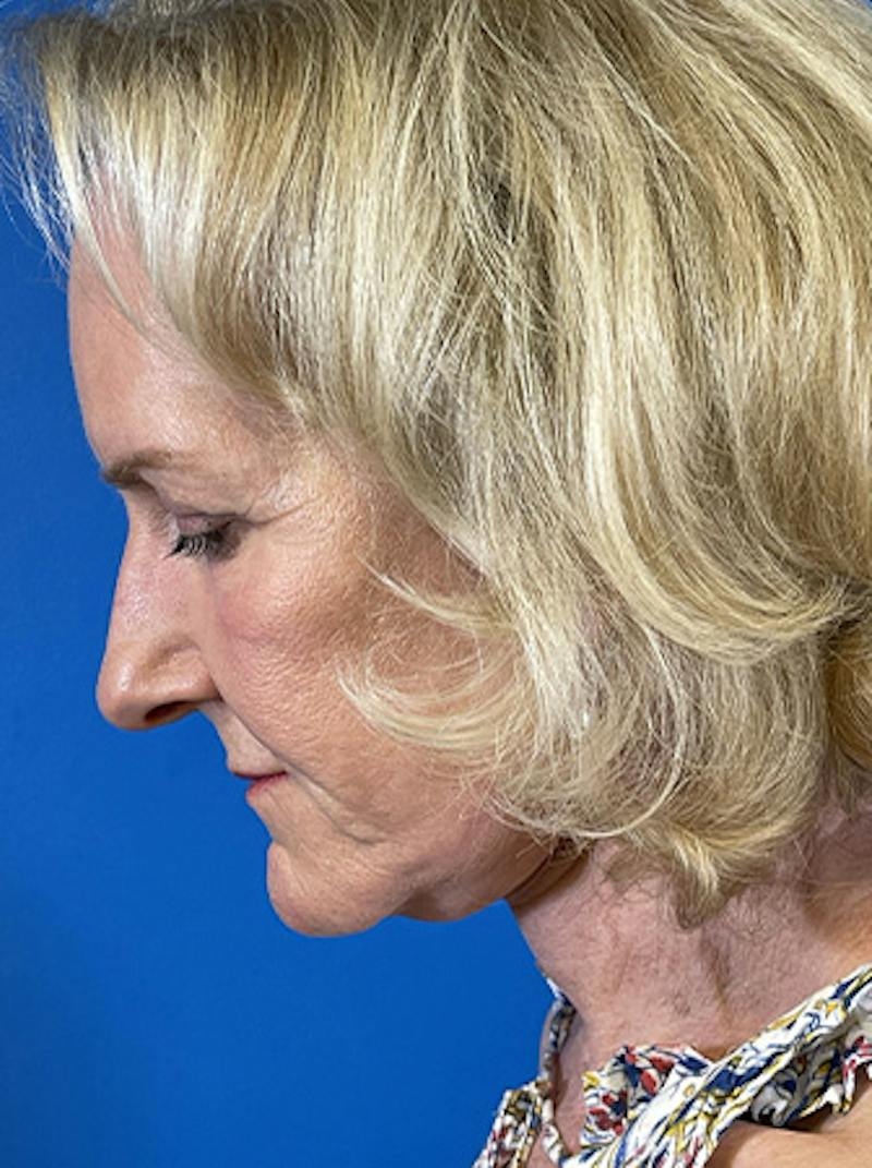 Facelift Before & After Gallery - Patient 313354 - Image 6