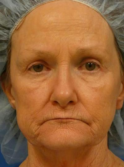 Facelift Before & After Gallery - Patient 255187 - Image 1